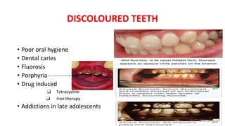 DISCOLOURED TEETH
• Poor oral hygiene
• Dental caries
• Fluorosis
• Porphyria
• Drug induced
❑ Tetracycline
❑ Iron therapy
• Addictions in late adolescents
 