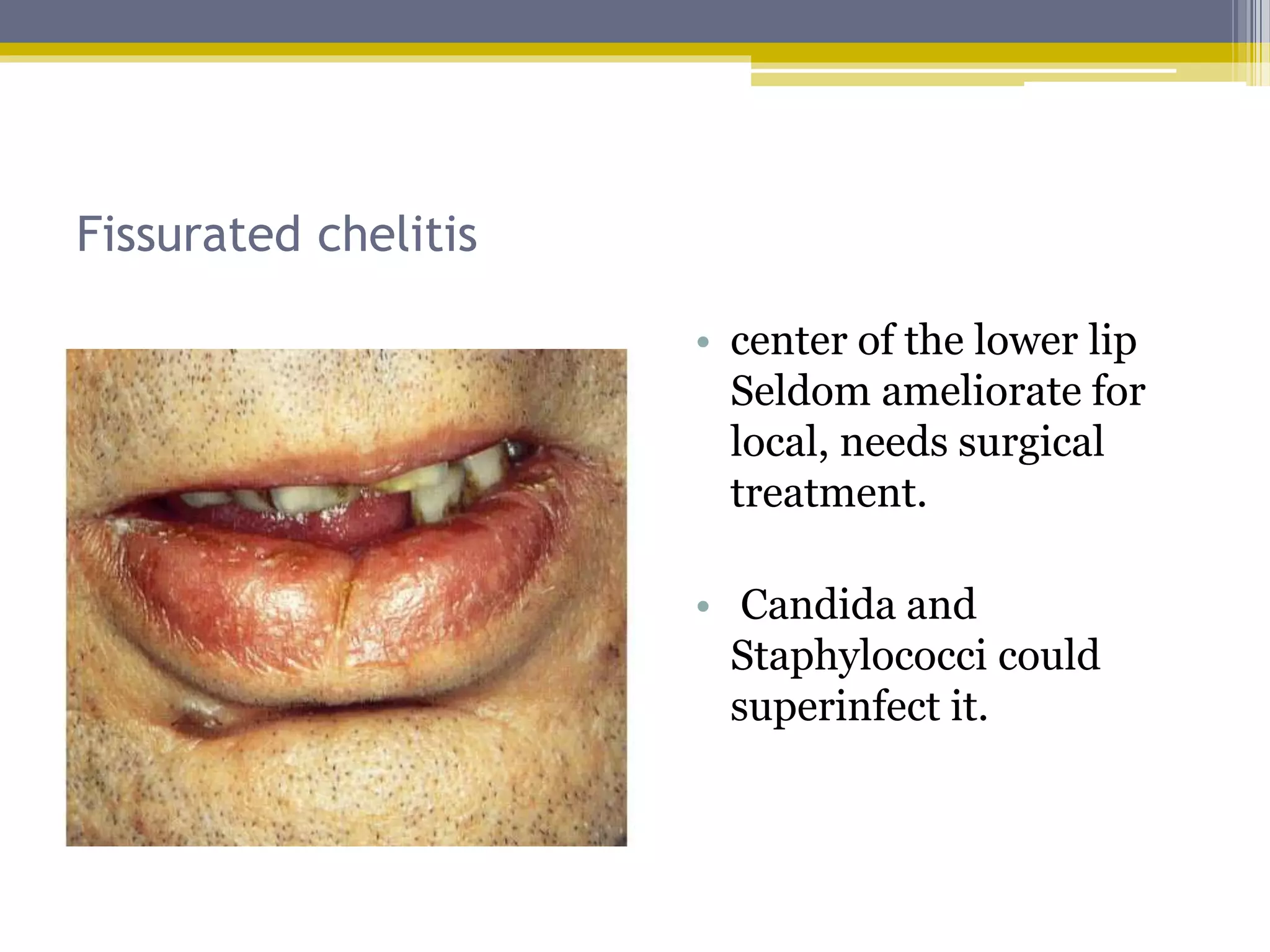 Disorders of lip | PPTX