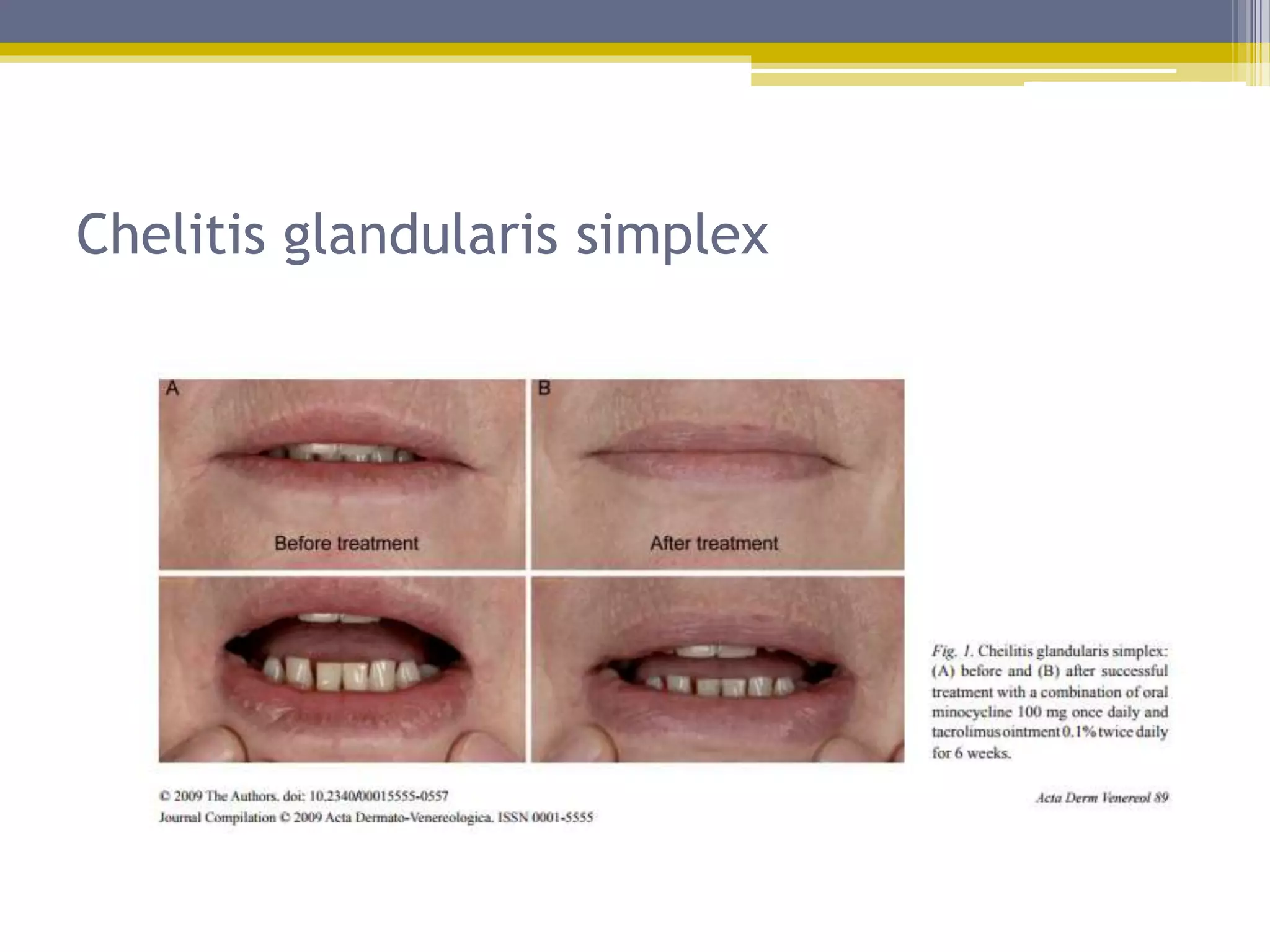 Disorders of lip | PPTX