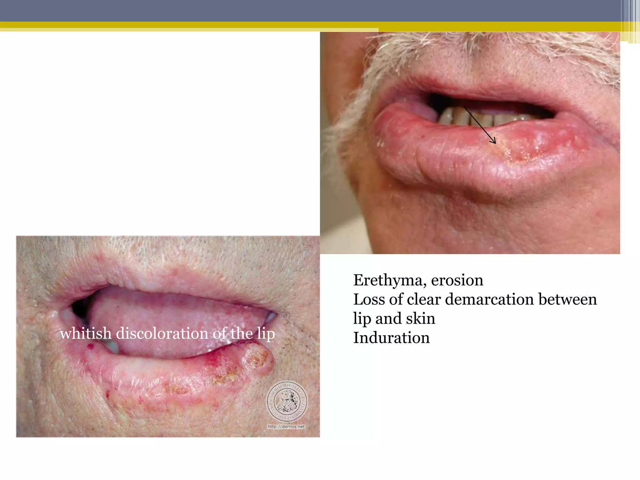 Disorders of lip | PPTX