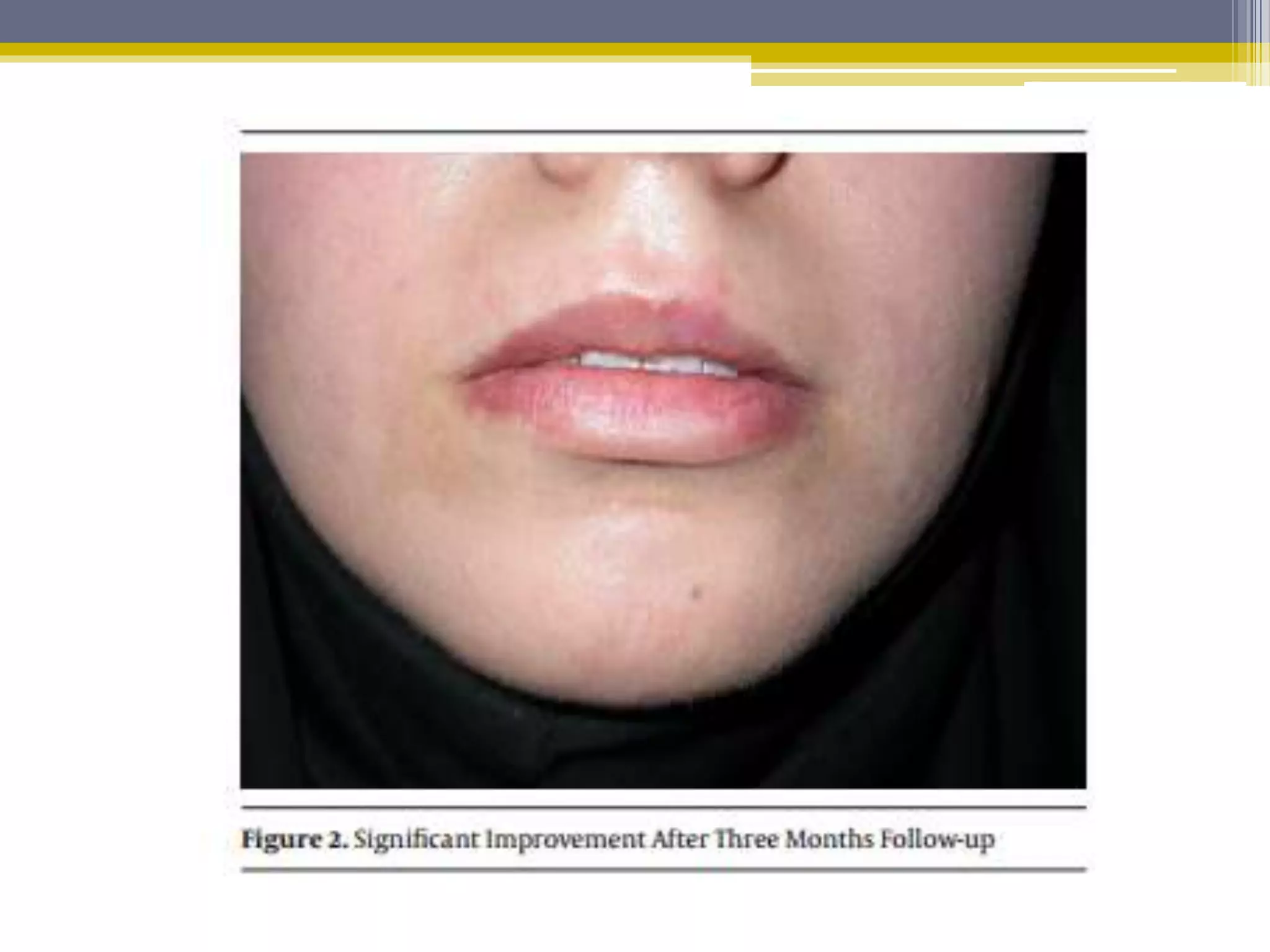 Disorders of lip | PPTX