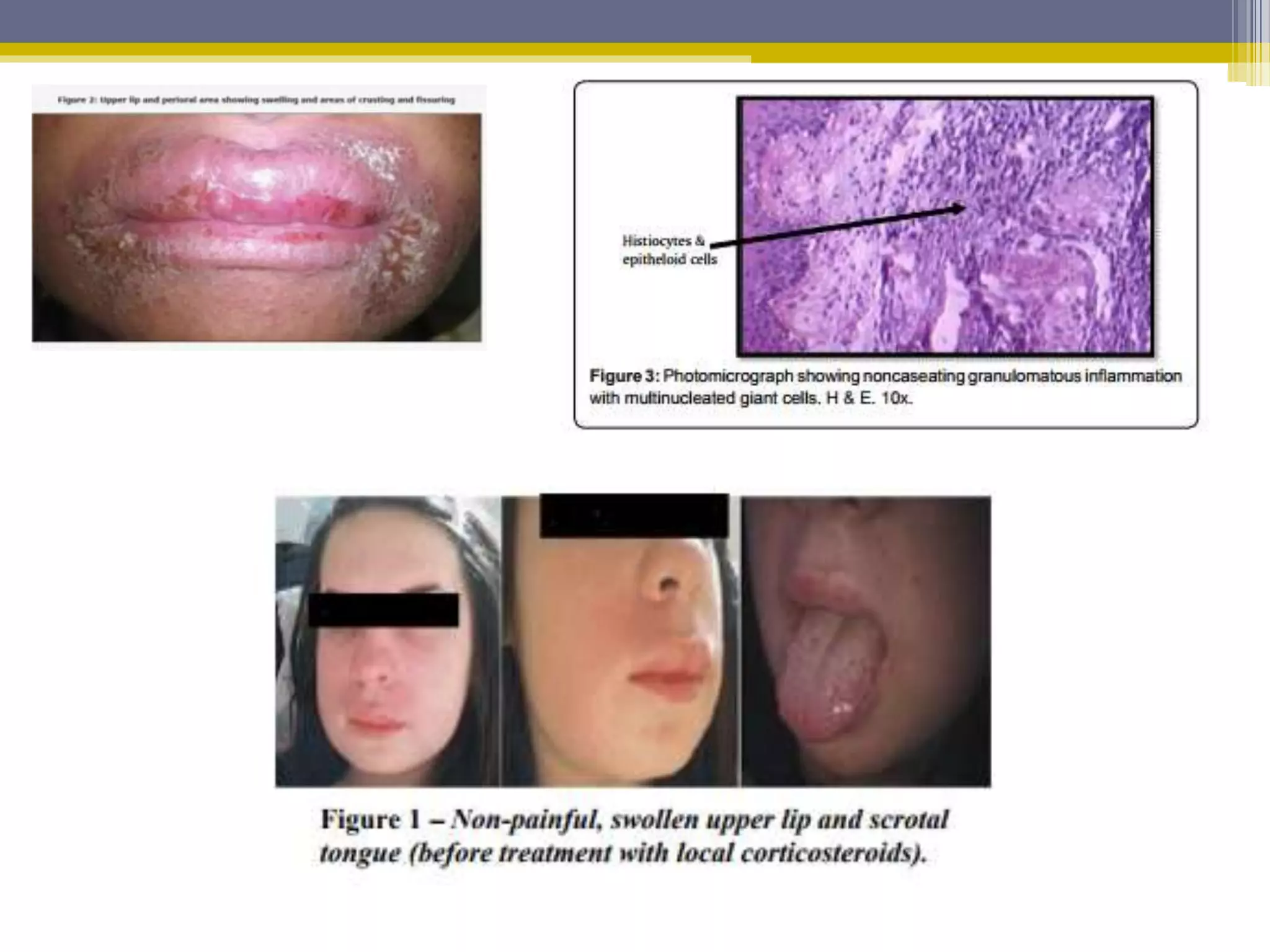 Disorders of lip | PPTX