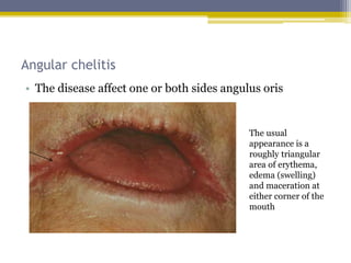Disorders of lip | PPTX