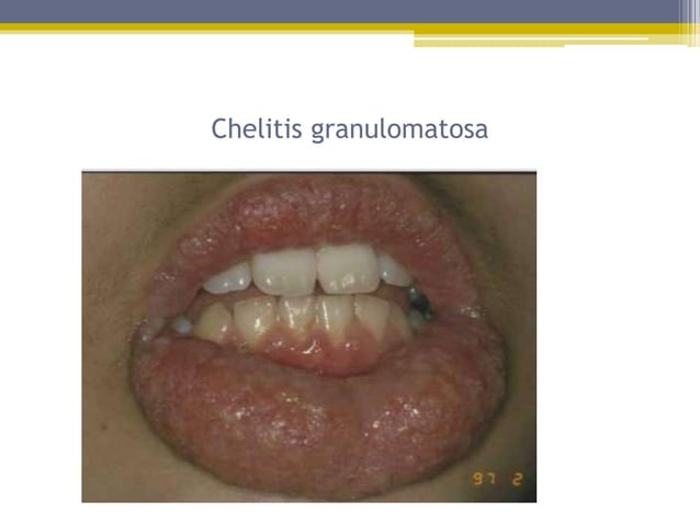 Disorders of lip | PPTX