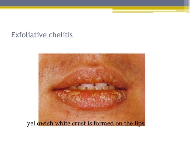 Disorders of lip Disorders of lip