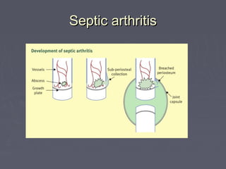 Septic arthritisSeptic arthritis
 
