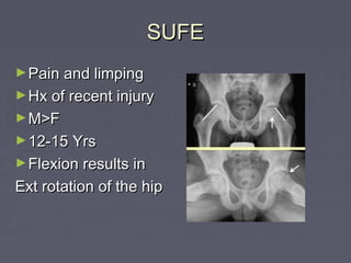 SUFESUFE
►Pain and limpingPain and limping
►Hx of recent injuryHx of recent injury
►M>FM>F
►12-15 Yrs12-15 Yrs
►Flexion results inFlexion results in
Ext rotation of the hipExt rotation of the hip
 