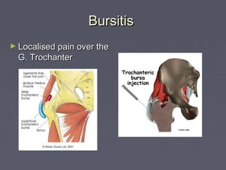 BursitisBursitis
► Localised pain over theLocalised pain over the
G. TrochanterG. Trochanter
 