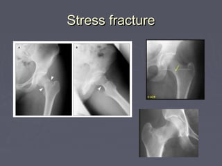 Stress fractureStress fracture
 