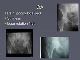 OAOA
►Pain, poorly localisedPain, poorly localised
►StiffnessStiffness
►Lose rotation firstLose rotation first
 