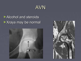AVNAVN
►Alcohol and steroidsAlcohol and steroids
►Xrays may be normalXrays may be normal
 