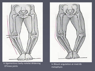 In ligamentous laxity notelat.Widening
Of knee joints
In Blount angulation at med.tib
metaphysis
 