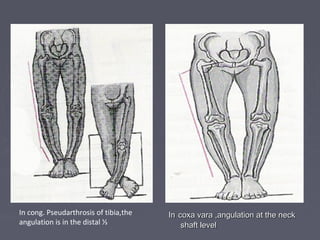 InIn coxa vara ,angulation at the neckcoxa vara ,angulation at the neck
shaft levelshaft level
In cong. Pseudarthrosis of tibia,the
angulation is in the distal ⅓
 