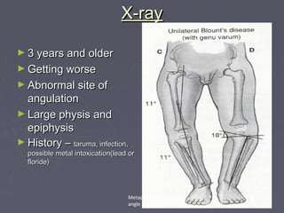 X-rayX-ray
► 3 years and older3 years and older
► Getting worseGetting worse
► Abnormal site ofAbnormal site of
angulationangulation
► Large physis andLarge physis and
epiphysisepiphysis
► History –History – taruma, infection,taruma, infection,
possible metal intoxication(lead orpossible metal intoxication(lead or
floride)floride)
Metaphysial/diaphysial
angle ≥ 18°
 