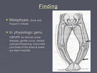 FindingFinding
► Metaphysis,Metaphysis, thick andthick and
frayed in ricketsfrayed in rickets
► InIn physiologic genuphysiologic genu
varumvarum no intrinsic boneno intrinsic bone
disease, gentle curve, medialdisease, gentle curve, medial
cortices thickening, horizontalcortices thickening, horizontal
joint lines of the knee & anklejoint lines of the knee & ankle
are tilted mediallyare tilted medially
 
