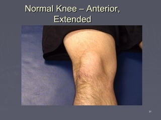 31
Normal Knee – Anterior,Normal Knee – Anterior,
ExtendedExtended
 