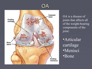 OAOA
OA is a disease of
joints that affects all
of the weight-bearing
components of the
joint:
•Articular
cartilage
•Menisci
•Bone
 