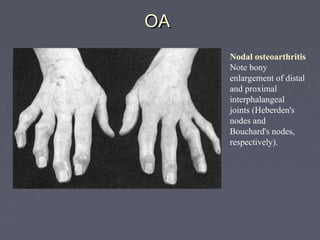 OAOA
Nodal osteoarthritis
Note bony
enlargement of distal
and proximal
interphalangeal
joints (Heberden's
nodes and
Bouchard's nodes,
respectively).
 