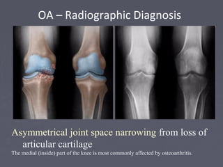 Asymmetrical joint space narrowing from loss of
articular cartilage
The medial (inside) part of the knee is most commonly affected by osteoarthritis.
OA – Radiographic Diagnosis
 