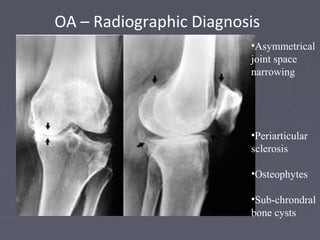 OA – Radiographic Diagnosis
•Asymmetrical
joint space
narrowing
•Periarticular
sclerosis
•Osteophytes
•Sub-chrondral
bone cysts
 