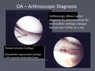 OA – Arthroscopic Diagnosis
Normal Articular Cartilage
Ostearthritic degenerated cartilage
with exposed subchondral bone
Arthroscopy allows earlier
diagnosis by demonstrating the
more subtle cartilage changes
that are not visible on x-ray
 