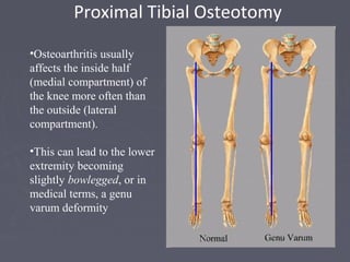 •Osteoarthritis usually
affects the inside half
(medial compartment) of
the knee more often than
the outside (lateral
compartment).
•This can lead to the lower
extremity becoming
slightly bowlegged, or in
medical terms, a genu
varum deformity
Proximal Tibial Osteotomy
 