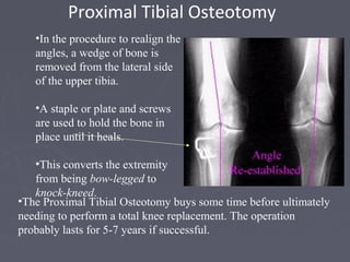 Proximal Tibial Osteotomy
•In the procedure to realign the
angles, a wedge of bone is
removed from the lateral side
of the upper tibia.
•A staple or plate and screws
are used to hold the bone in
place until it heals.
•This converts the extremity
from being bow-legged to
knock-kneed.
•The Proximal Tibial Osteotomy buys some time before ultimately
needing to perform a total knee replacement. The operation
probably lasts for 5-7 years if successful.
 