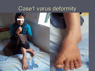 Case1 varus deformityCase1 varus deformity
 