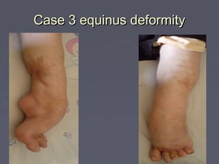 Case 3 equinus deformityCase 3 equinus deformity
 