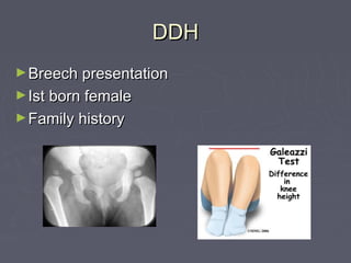 DDHDDH
►Breech presentationBreech presentation
►Ist born femaleIst born female
►Family historyFamily history
 