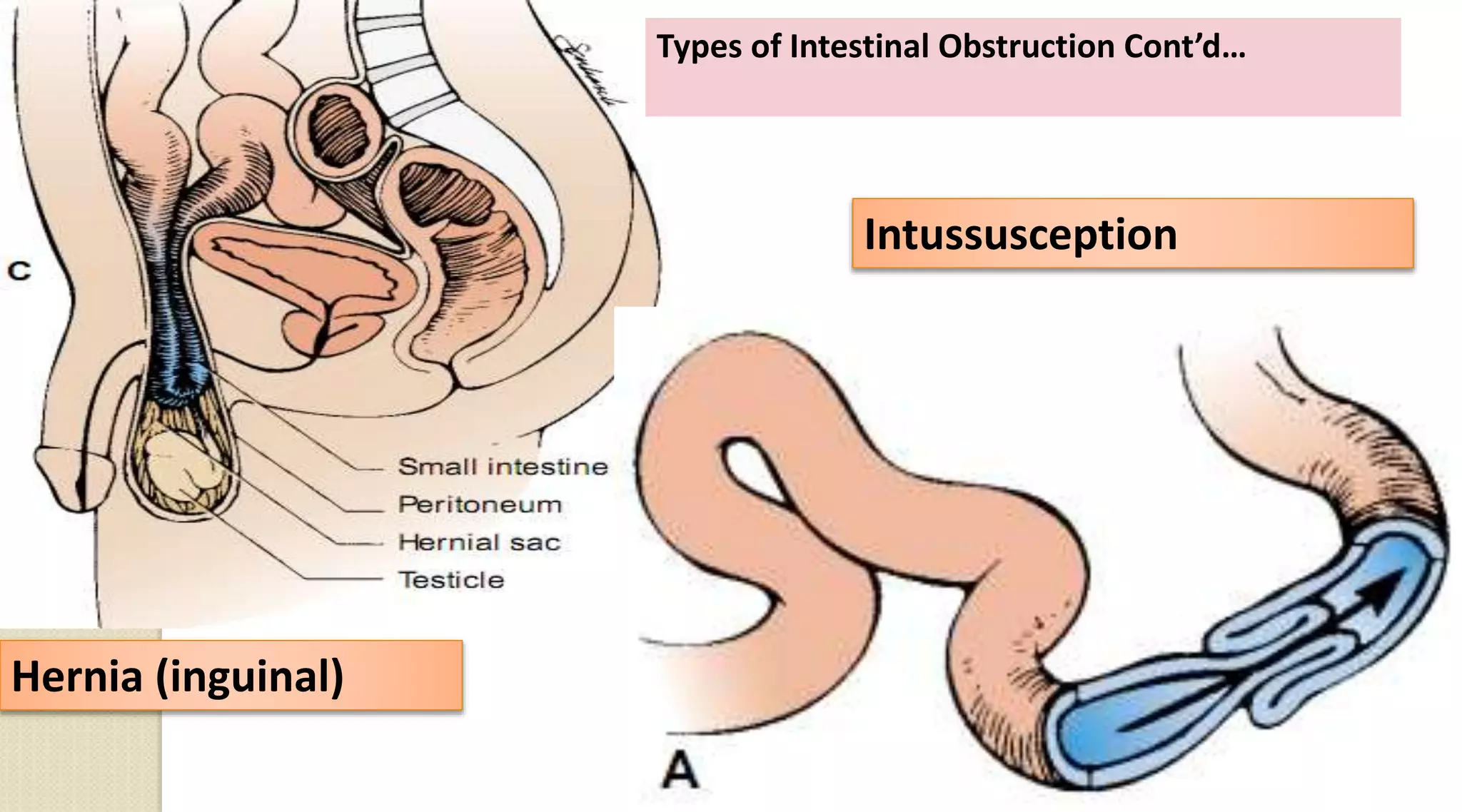 Hernia (inguinal)
Intussusception
Types of Intestinal Obstruction Cont’d…
102
 