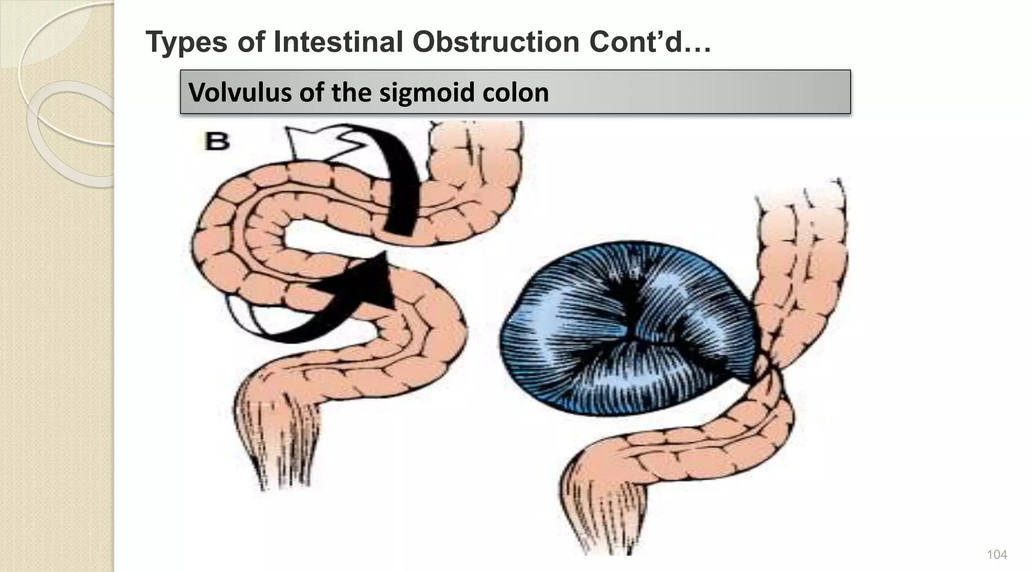 Volvulus of the sigmoid colon
Types of Intestinal Obstruction Cont’d…
104
 