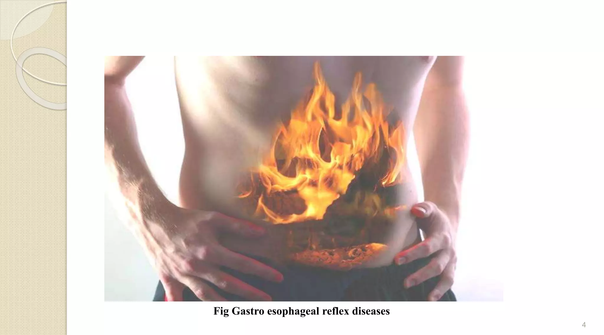 4
Fig Gastro esophageal reflex diseases
 