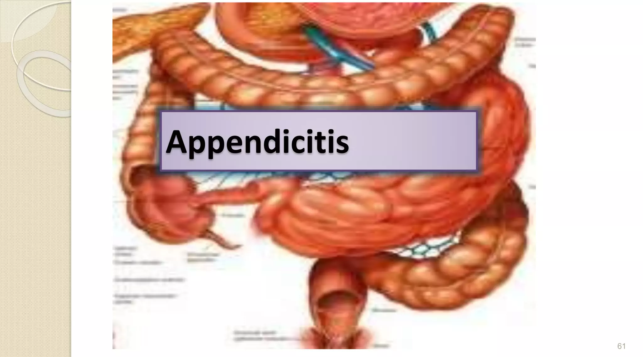 Appendicitis
61
 