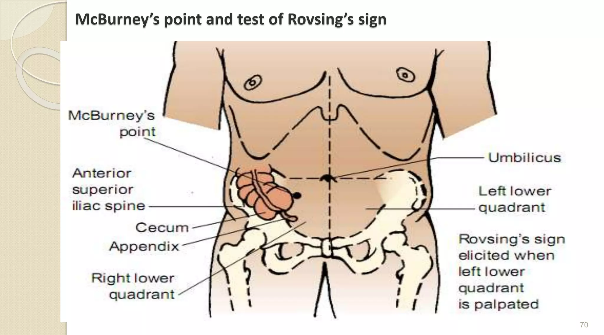 McBurney’s point and test of Rovsing’s sign
70
 