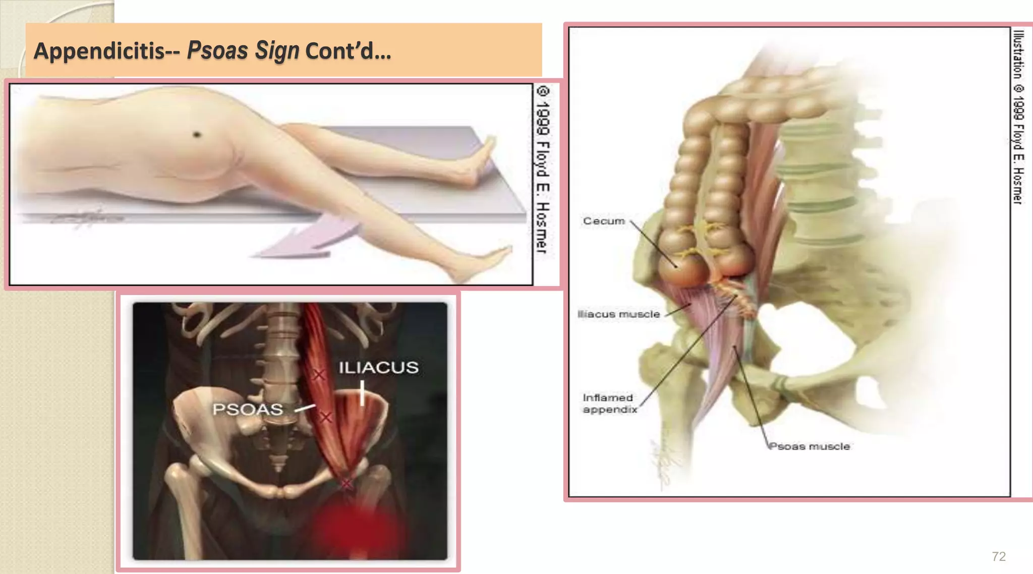 Appendicitis-- Psoas Sign Cont’d…
72
 