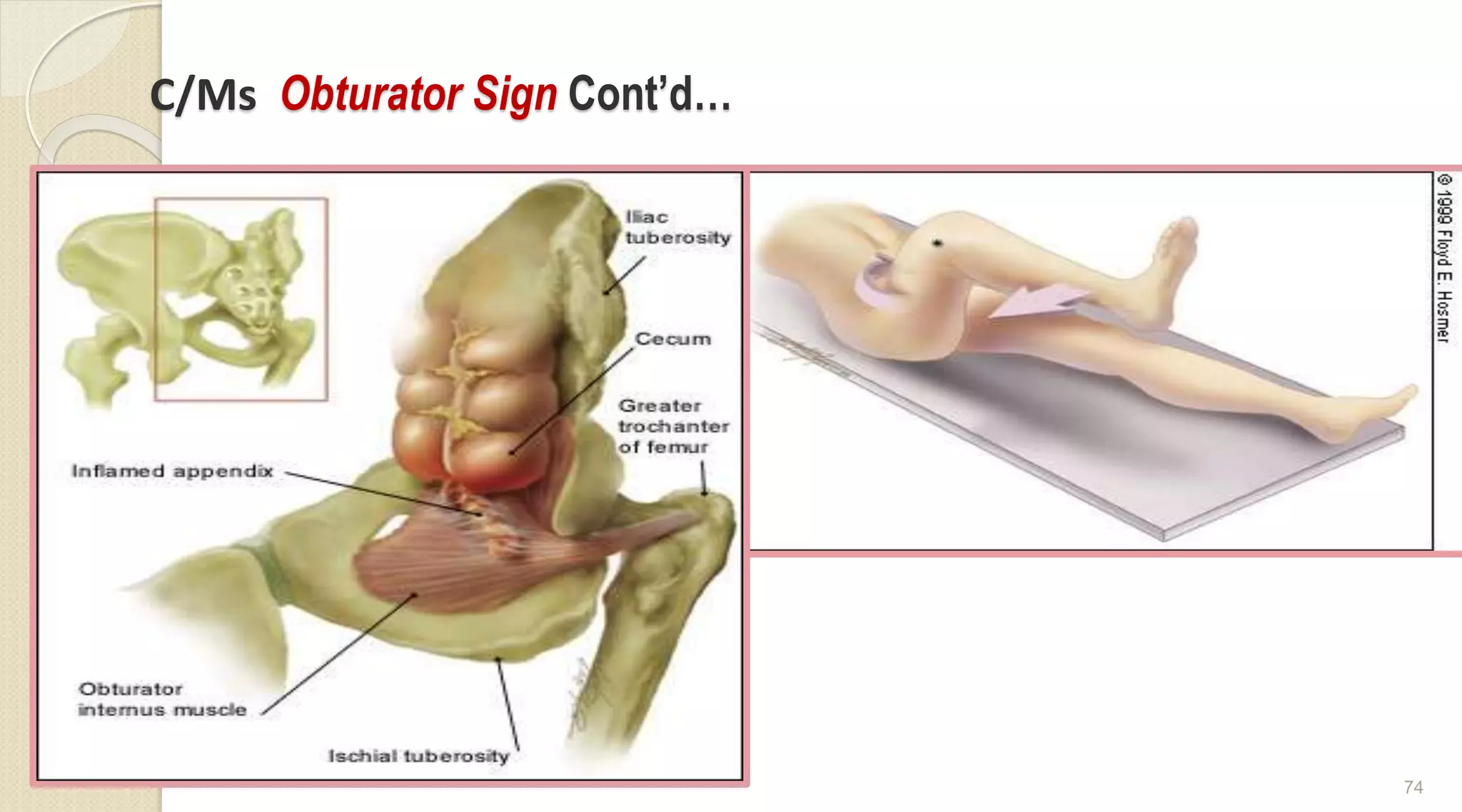 C/Ms Obturator Sign Cont’d…
74
 