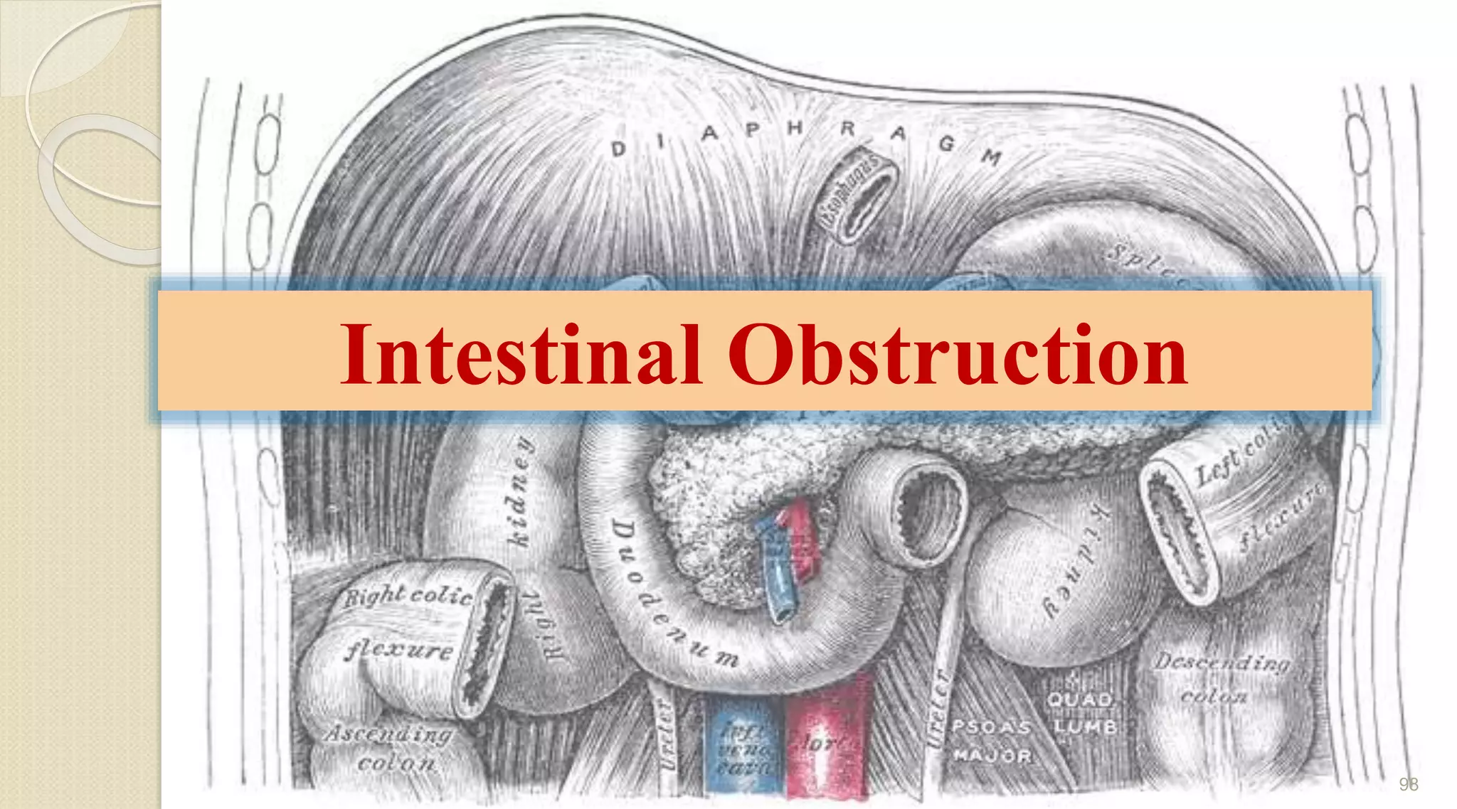 Intestinal Obstruction
98
 