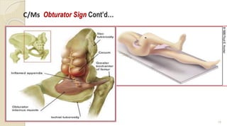 Testing Obturator Sign Disorders of Lower GIT system Ppt (3).ppt