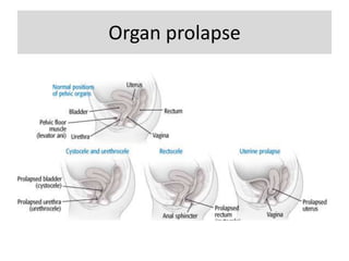 Organ prolapse
 