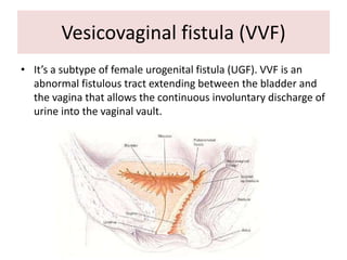 Vesicovaginal fistula (VVF)
• It’s a subtype of female urogenital fistula (UGF). VVF is an
abnormal fistulous tract extending between the bladder and
the vagina that allows the continuous involuntary discharge of
urine into the vaginal vault.
 