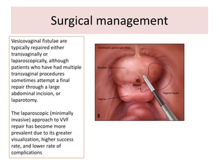 Surgical management
Vesicovaginal fistulae are
typically repaired either
transvaginally or
laparoscopically, although
patients who have had multiple
transvaginal procedures
sometimes attempt a final
repair through a large
abdominal incision, or
laparotomy.
The laparoscopic (minimally
invasive) approach to VVF
repair has become more
prevalent due to its greater
visualization, higher success
rate, and lower rate of
complications
 