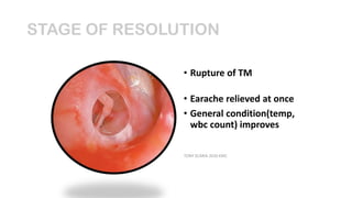 Disorders of middle ear revision notes | PDF