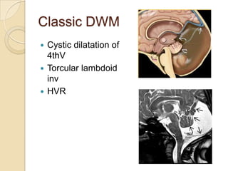Torcular Inversion Disorders of neural tube closure and neuronal migration | PPTX
