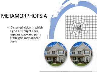 Disorders of perception | PPTX