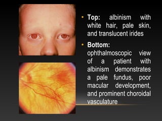 Disorders of pigmentation | PPT