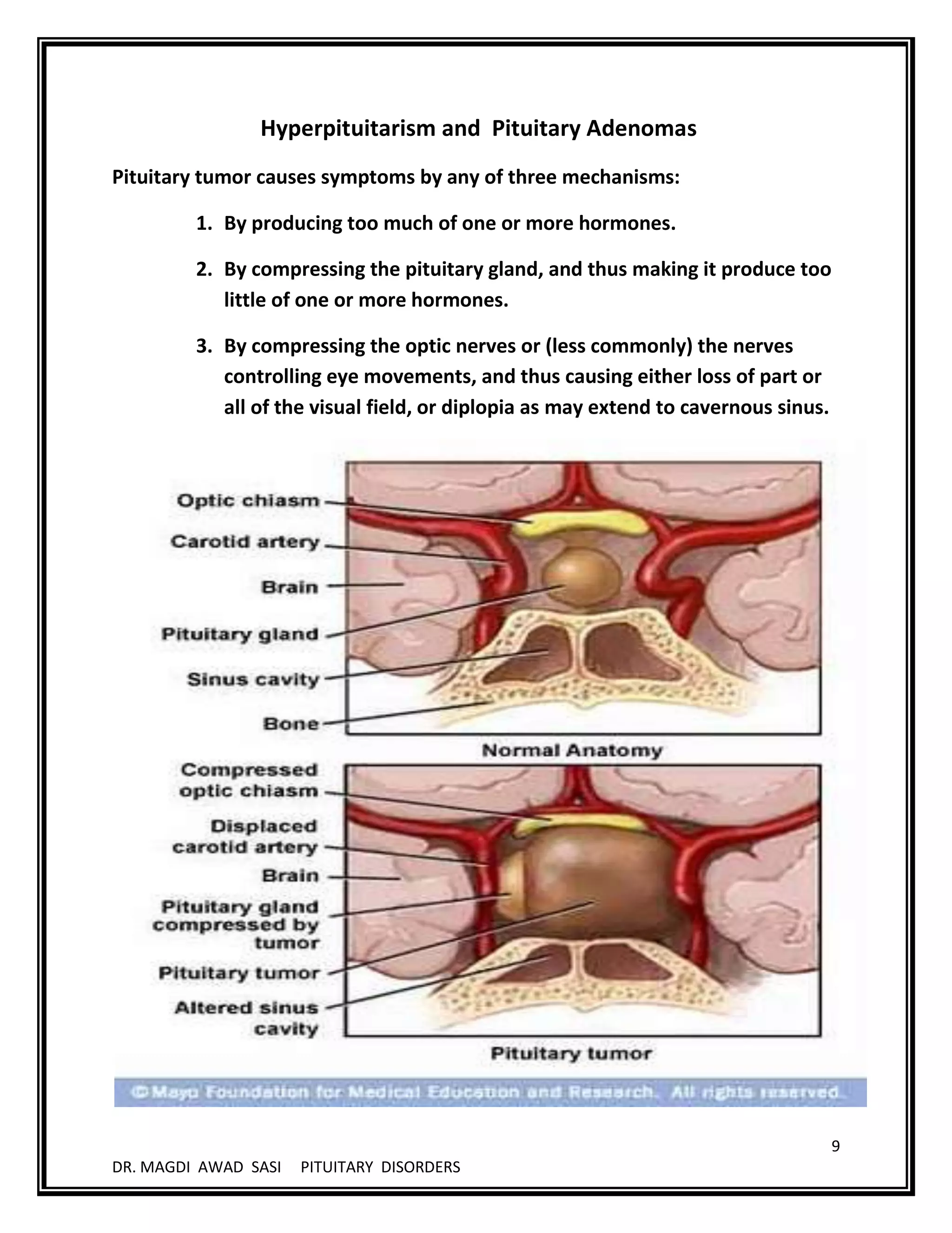 Disorders of pituitary gland (( THE MASTER )) BY M.SASI