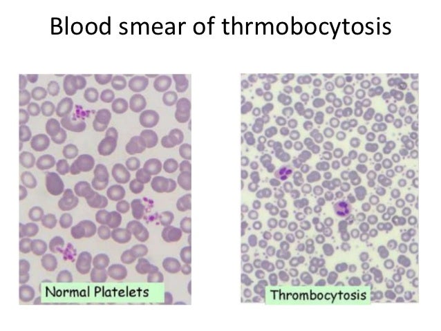 What are the elevated leukocytes in the blood of children What are the elevated leukocytes in the blood of children