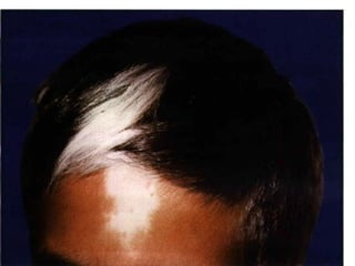 dermatology.Disorders of skin color.(dr.ali) | PPT
