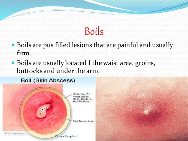 Pus And Blood Filled Bumps On Buttocks Blisters Sometimes